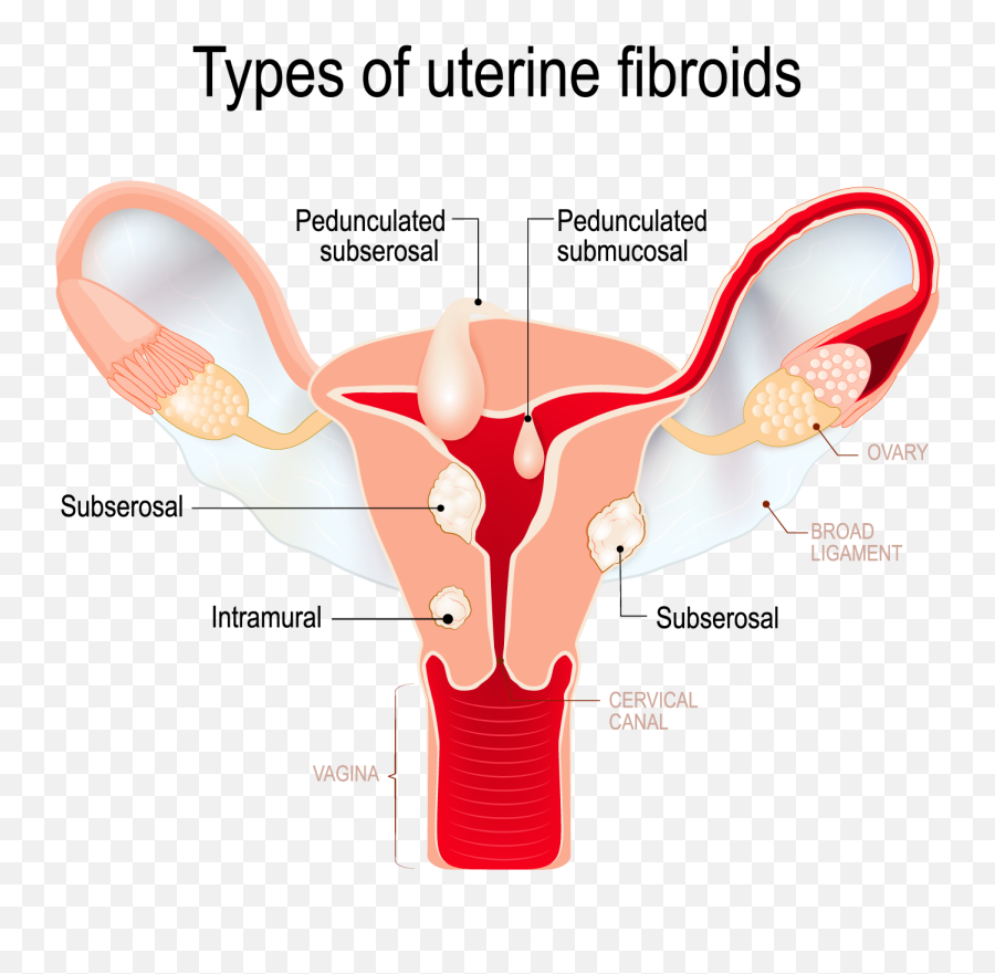 Uterine Fibroids And Polyps - Pedunculated Fibroid Emoji,Entrance Ovary Emotion