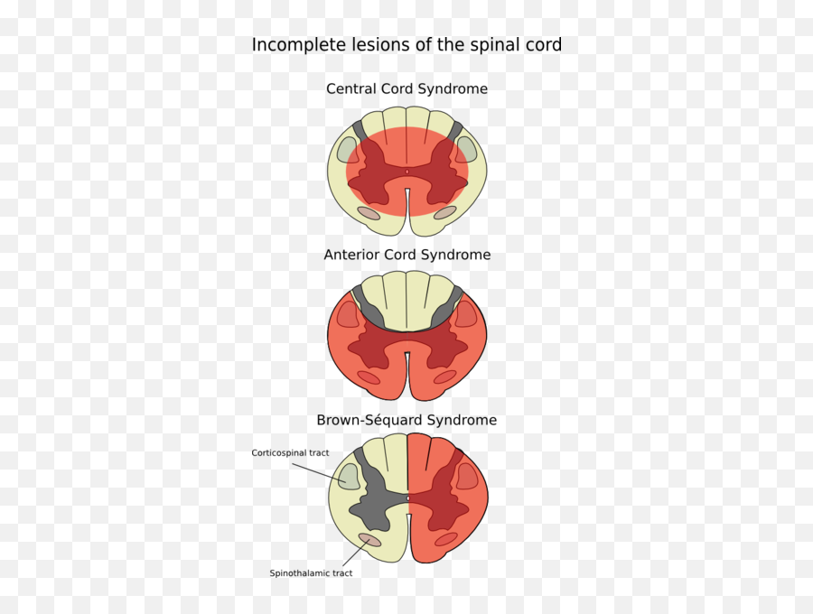 Aiims Mcqs Questions And Answers - Aiims Wwwmedicaltalk Brown Sequard Syndrome Emoji,Meningioma Affects Areas Of Brain Right Occipital Emotions