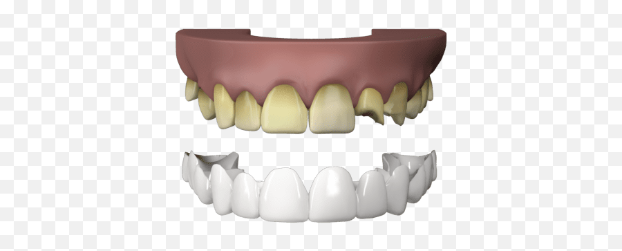 Press On Veneers Archives - Brighter Image Lab Horizontal Emoji,Gums And Emotions Chart