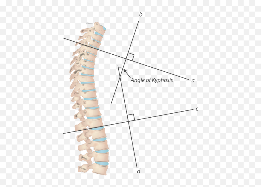 Dowageru0027s Hump What Is It And How Can You Treat And Prevent It - Vertical Emoji,Emotion Trap In The Spine