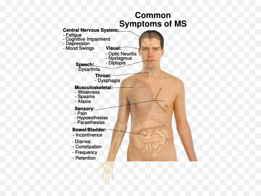 Multiple Sclerosis Specialist Advice - Multiple Sclerosis People With Ms Emoji,Ms And Emotions