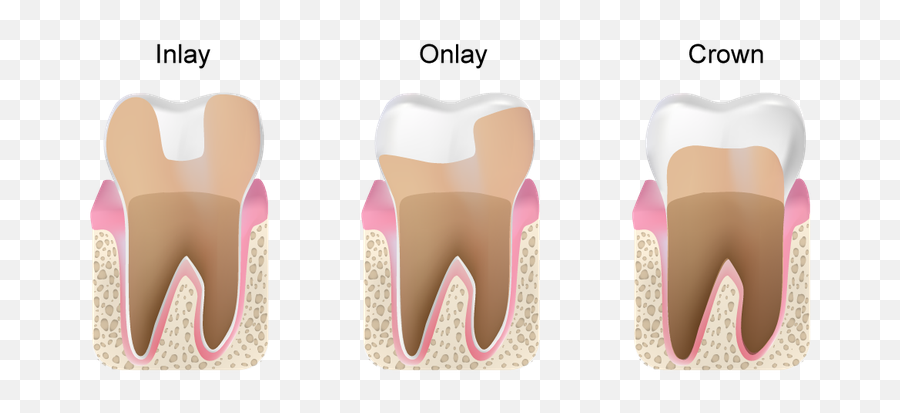 Dental Inlays And Onlays Are They Better Than Crowns - Vertical Emoji,Grinding Teeth Emoji