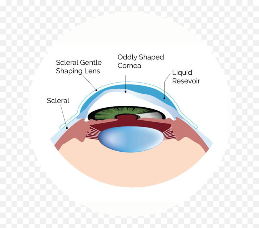 Looking For Scleral Contact Lenses In San Diego - Scleral Contact Lenses Emoji,Mia Rodriguez Emotion