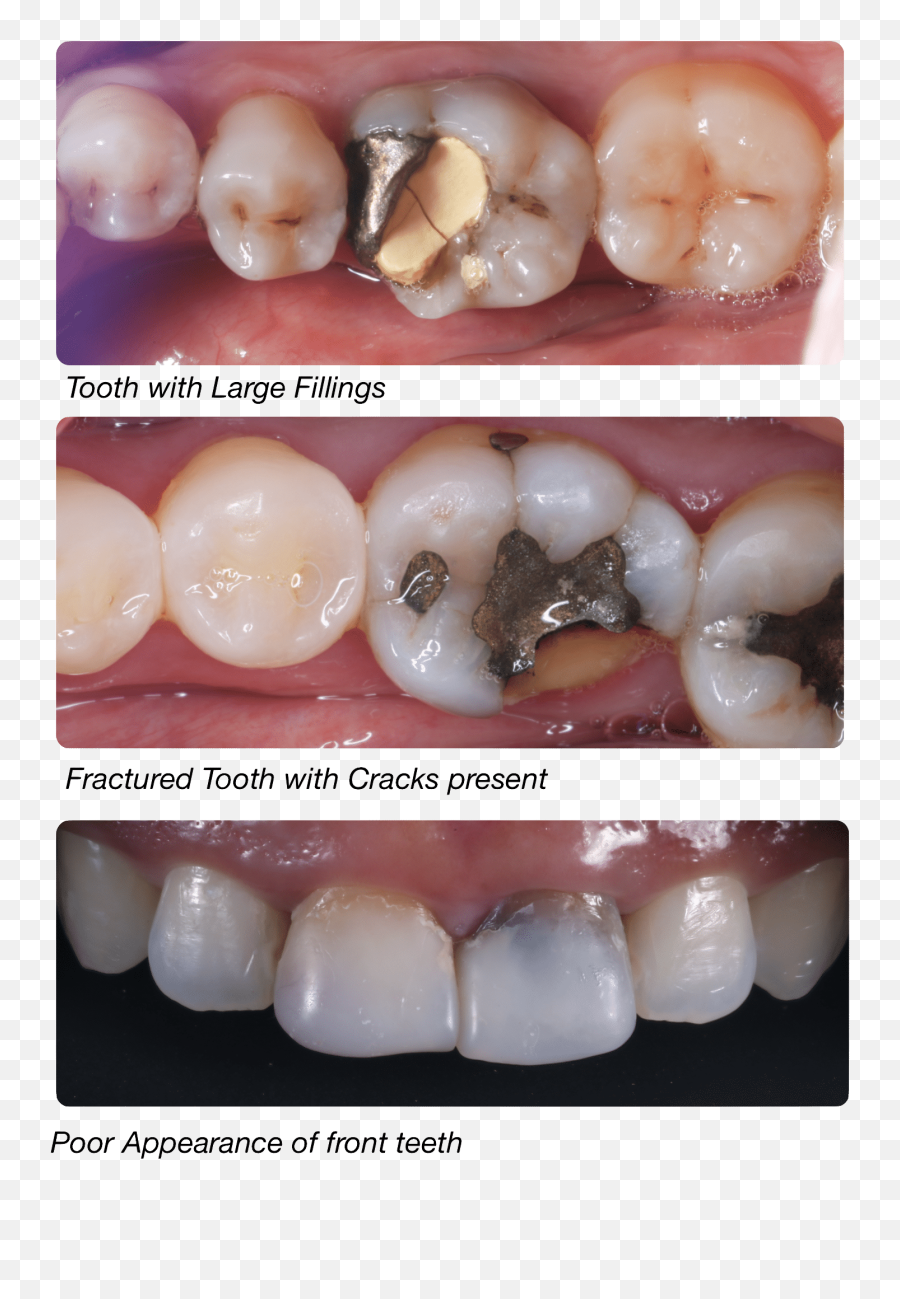 Cracked Tooth After Root Canal Emoji,Chipped Tooth Emoticon