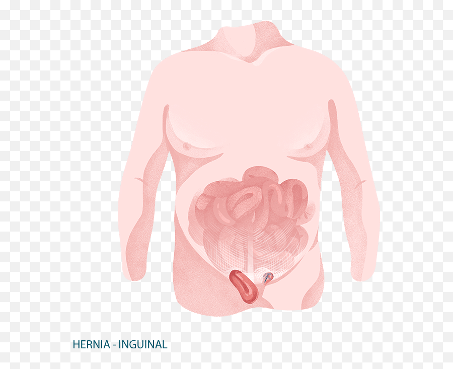 Inguinal Hernia Surgery U2013 Dr Mark Magdy - For Adult Emoji,Testicle Trapped Emotion