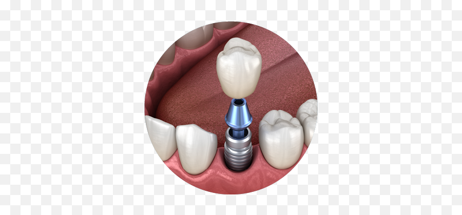 Single Full - Dental Implants Emoji,Missing Tooth Emoticon -smiley -emoji
