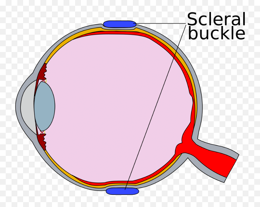 Retinal Detachment Ophthalmology Geeky Medics - Cross Section Of Eye Clipbart Emoji,Slit Eye Emoticon