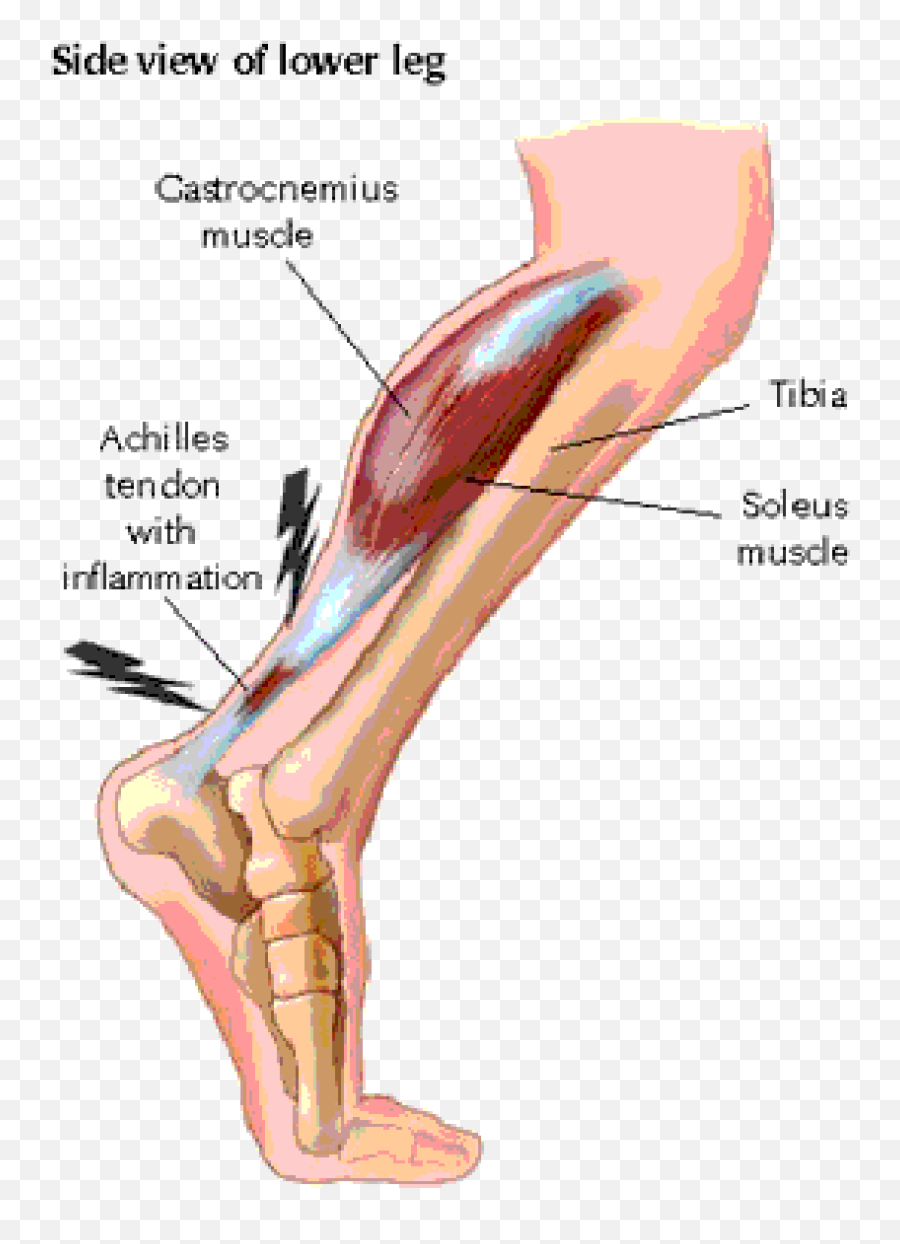 Pin By Ana On Sports Injury Fixes Sports Injury Injury - Ruptured Achilles Emoji,How Do You Show The Emotion Spells For Tibia