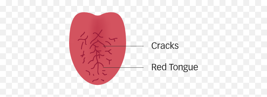 What Your Tongue Reflects About Your Health - Pulse Tcm Emoji,Small Tongue Out Emoticon Face