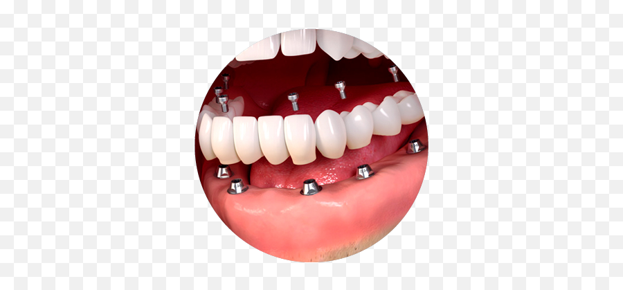 Single Full - Bridge Implant Teeth Emoji,Missing Tooth Emoticon -smiley -emoji