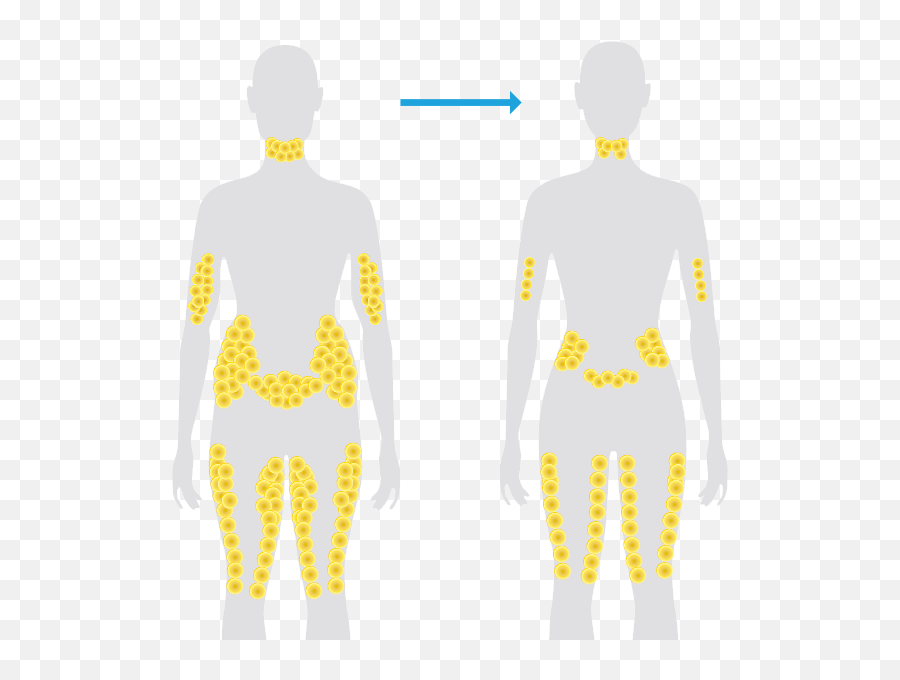 Toronto Coolsculpting Coolsculpting Cost Coolsculpting - Fat Is Stored In Our Body Emoji,Emotions Stored In Fat Cells And Muscles