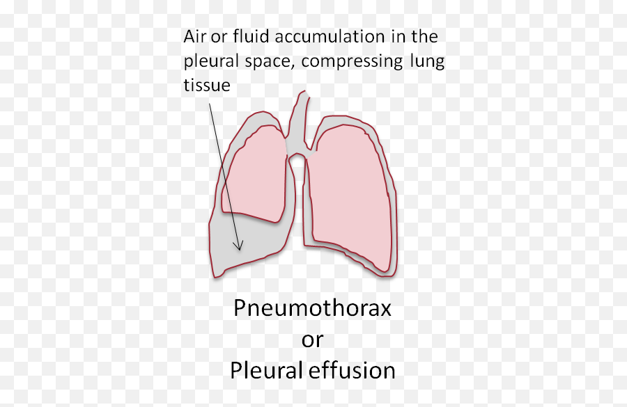 Pathophysiology Quiz 6 Flashcards Cheggcom Emoji,Emotions Relating To Ribs And Intercostals