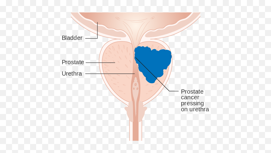 Prostate Cancer Nursing Ceu Wild Iris Medical Education Emoji,Kava Dulls Emotion