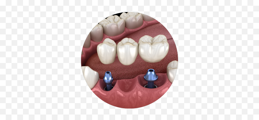 Single Full - Bridge Emoji,Missing Tooth Emoticon -smiley -emoji