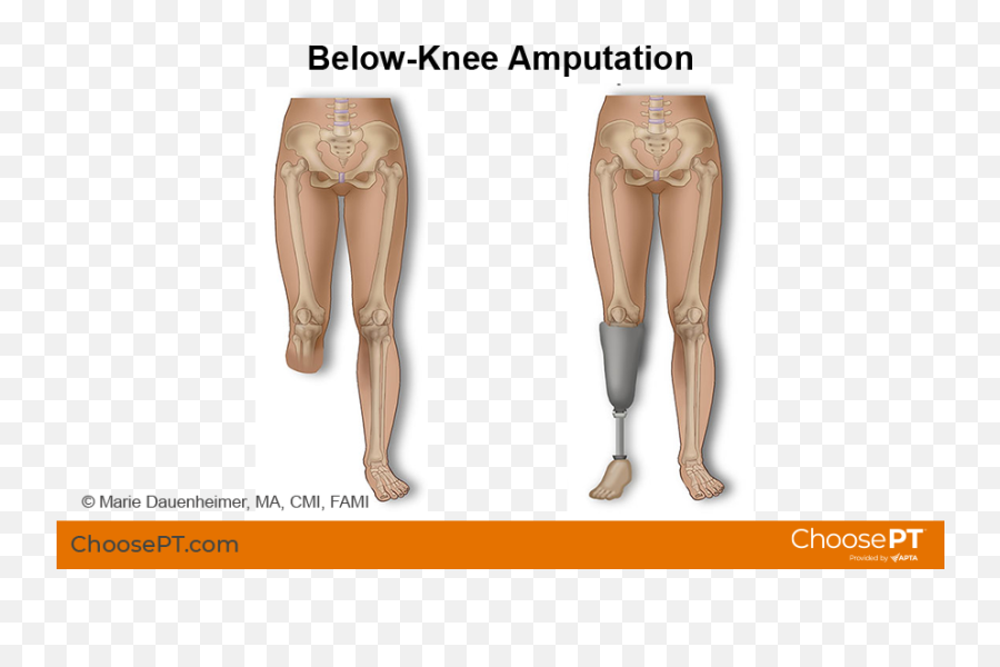 Guide Physical Therapy Guide To Below - Knee Amputation Emoji,Plucheck Weal Of Emotions