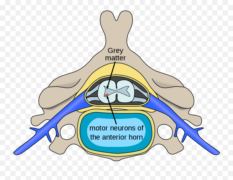 Motor Neuron Disease - Wikipedia Motor Neuron Disease Emoji,Girlfriend Cant Control Her Emotions During Pmg