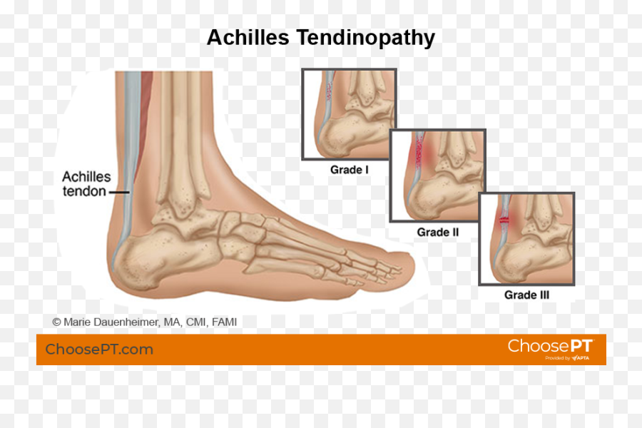 Guide Physical Therapy Guide To Achilles Tendinopathy Emoji,Plucheck Weal Of Emotions