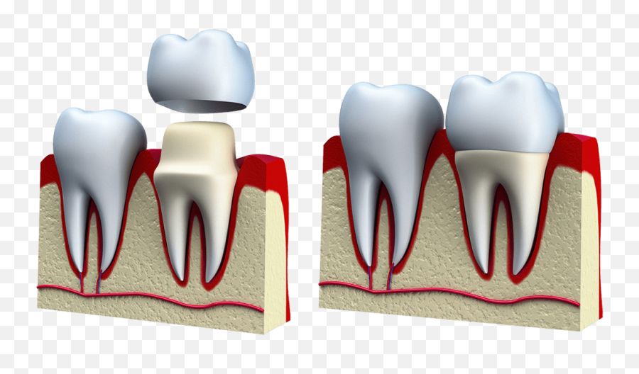 Treatments U2013 Downtown Dental Clinic - Dental Capping Emoji,Missing Tooth Emoticon