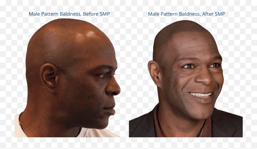 Scalp Micropigmentation For Male Pattern Baldness Smp For Emoji,Illness Can't Read People's Faces Emotions No Sexual Attraction