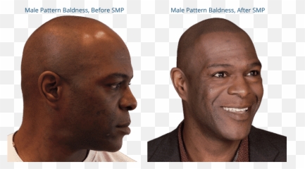 Scalp Micropigmentation For Male Pattern Baldness Smp For Emoji,Illness Can't Read People's Faces Emotions No Sexual Attraction
