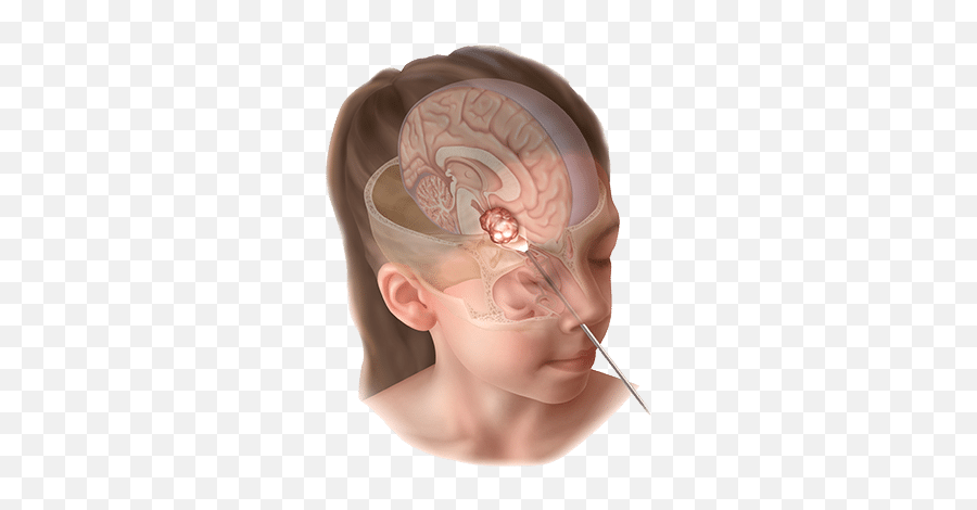 Endoscopic Brain Surgery Through Nose - Craniopharyngioma Emoji,Surgery Cut Open Brain And No Emotion