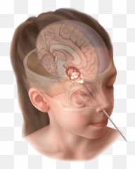 Endoscopic Brain Surgery Through Nose - Craniopharyngioma Emoji,Surgery Cut Open Brain And No Emotion