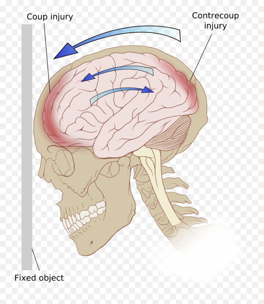 Opening The Skull To Do Brain Surgery - Focal Brain Lesions Emoji,Surgery Cut Open Brain And No Emotion