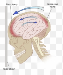 Opening The Skull To Do Brain Surgery - Focal Brain Lesions Emoji,Surgery Cut Open Brain And No Emotion