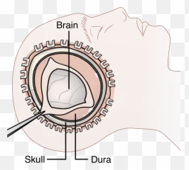 Decompressive Craniectomy - Dot Emoji,Surgery Cut Open Brain And No Emotion