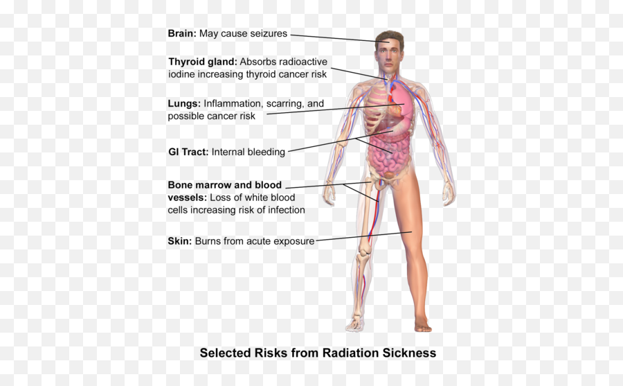 Radiation Side Effects And Syndromes - Physiopedia Emoji,How Emotions Effect Our Body With Infrared Images