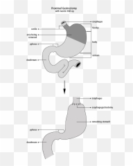 Surgery For Stomach Cancer - Proximal Gastrectomy Emoji,Surgery Cut Open Brain And No Emotion
