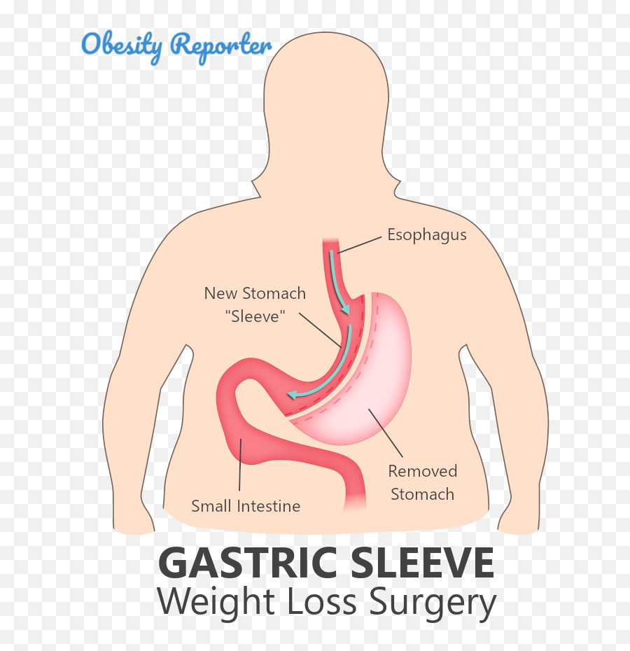 Gastric Sleeve Surgery Comprehensive Emoji,Surgery Cut Open Brain And No Emotion