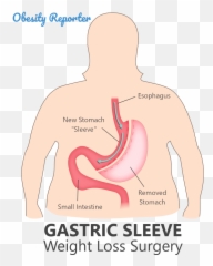 Gastric Sleeve Surgery Comprehensive Emoji,Surgery Cut Open Brain And No Emotion