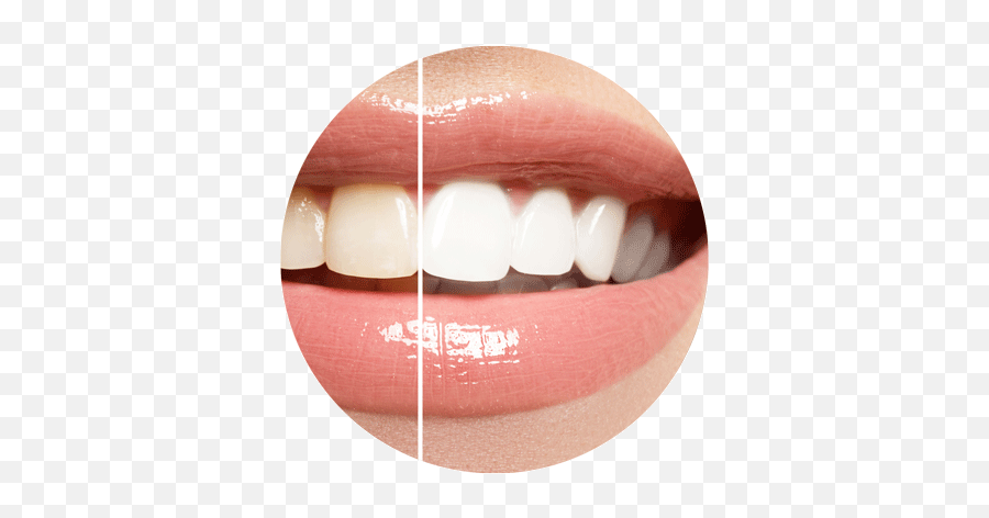 Cosmetic Dentistry Dr Dana Mandel Dmd Emoji,Biting Lower Lip Emoticon
