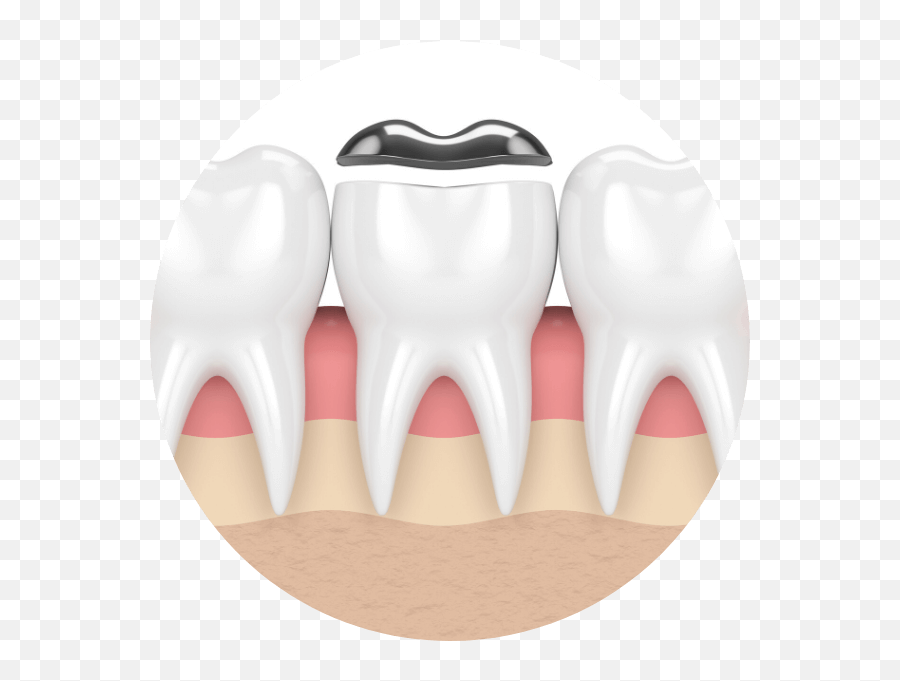 Dental Fillings Melbourne Emoji,Missing Tooth Emoticon -smiley -emoji