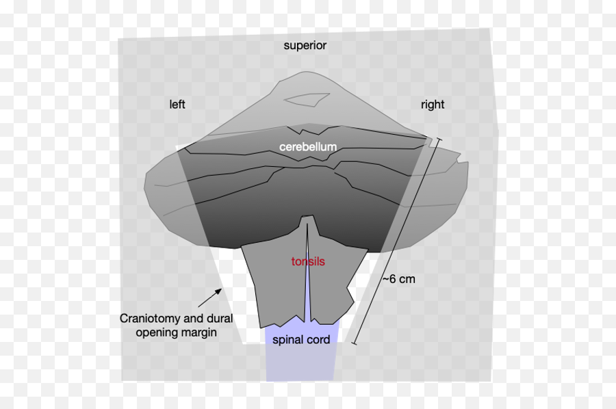 Chiari I Cerebellar Function Study - Vertical Emoji,Surgery Cut Open Brain And No Emotion