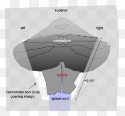 Chiari I Cerebellar Function Study - Vertical Emoji,Surgery Cut Open Brain And No Emotion