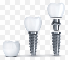 Dental Implants - Gundersen Dental Care Emoji,Light Bulb Emoticon Png Transparent Bg
