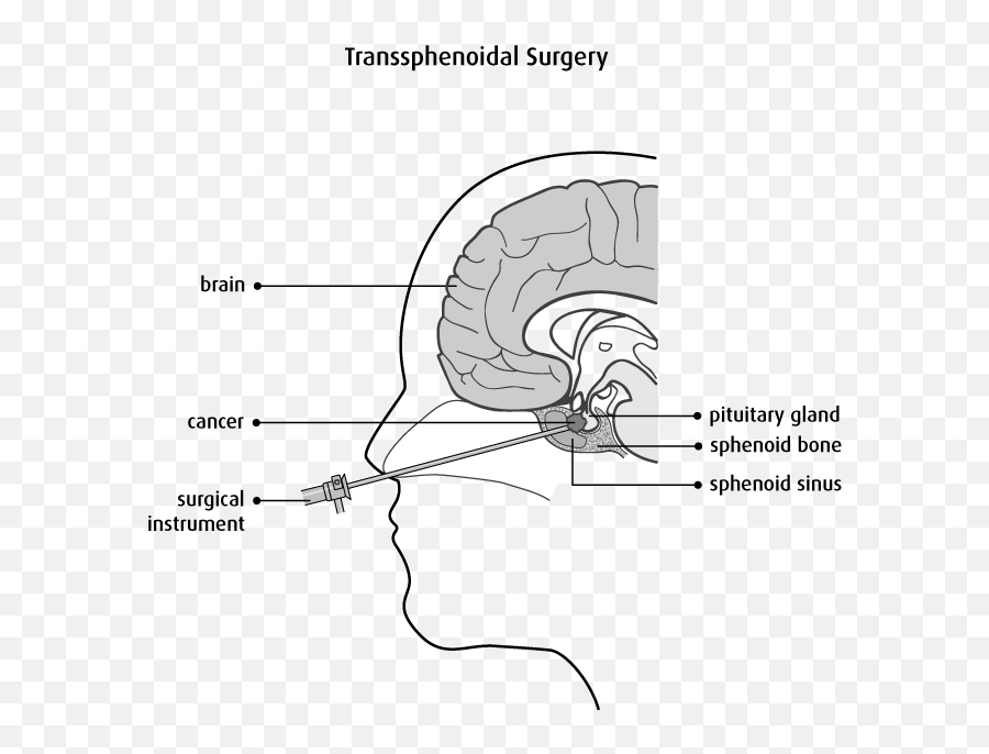 Childhood Brain And Spinal Cord Tumours - Transsphenoidal Craniotomy Emoji,Surgery Cut Open Brain And No Emotion