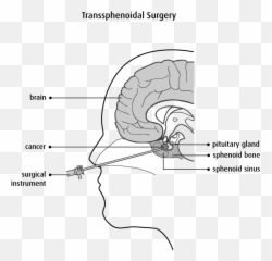 Childhood Brain And Spinal Cord Tumours - Transsphenoidal Craniotomy Emoji,Surgery Cut Open Brain And No Emotion