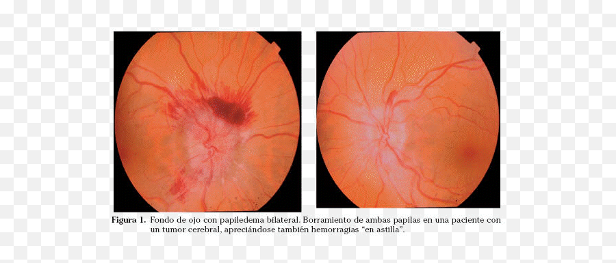 Cefalea En Urgencias - Fondo De Ojo En Migraña Emoji,Qie Significa A Emotion De Un Sobre Cerrado Que Significa