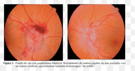 Cefalea En Urgencias - Fondo De Ojo En Migraña Emoji,Qie Significa A Emotion De Un Sobre Cerrado Que Significa