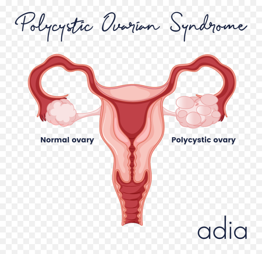 Pcos And Pregnancy Polycystic Ovary Syndrome And Fertility Emoji,Plucheck Weal Of Emotions