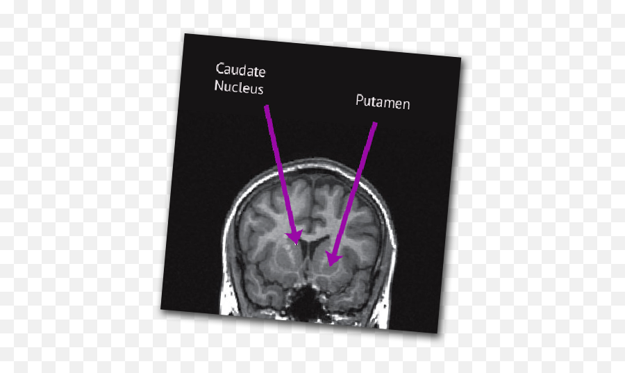 Huntingtons Disease - Disease Mri Emoji,Feer Emotion Mri