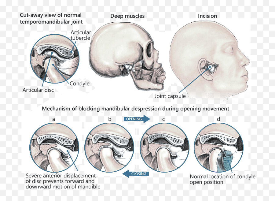 Tmj Physical Therapy Specialist Nyc - Temporomandibular Hd Emoji,Surgery Cut Open Brain And No Emotion