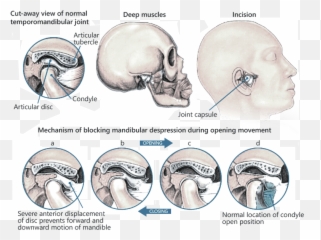 Tmj Physical Therapy Specialist Nyc - Temporomandibular Hd Emoji,Surgery Cut Open Brain And No Emotion