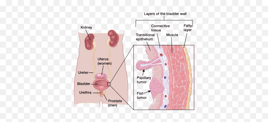 If You Have Bladder Cancer - Adjuvant Chemotherapy Emoji,But Its My Emotions Going In For The Kill