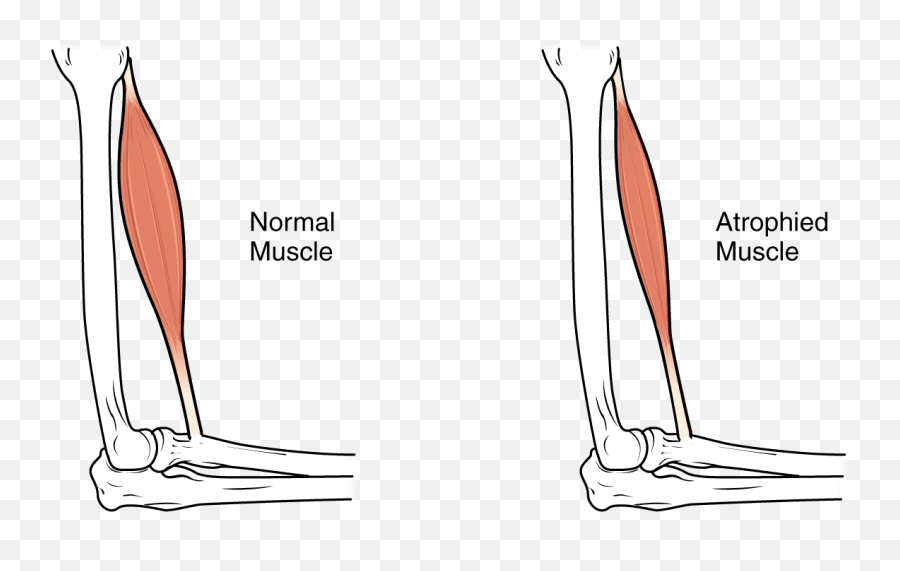 Download This Image Shows Muscle - Normal Muscle And Atrophied Muscle Emoji,Muscular Emoji