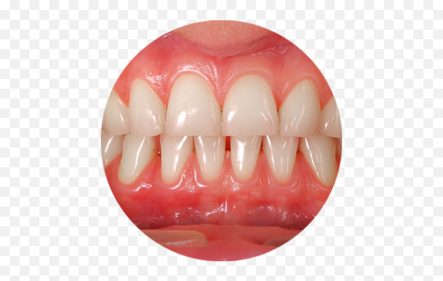 Gum Treatments - Stateoftheart Missoula Dentist Gums Teeth Emoji,Chewing Gum Hides Emotion