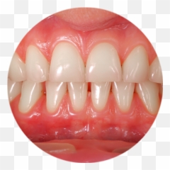 Gum Treatments - Stateoftheart Missoula Dentist Gums Teeth Emoji,Chewing Gum Hides Emotion